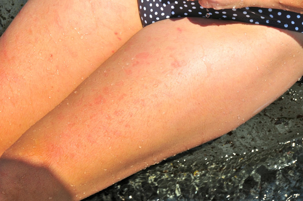 ... and then a burn from the stones!/